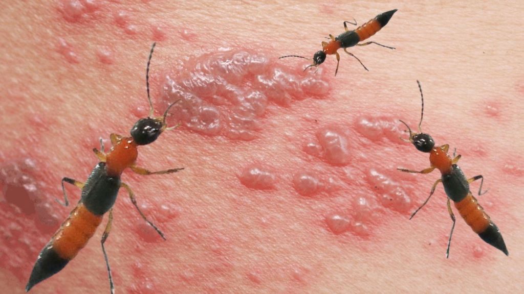 Kiến ba khoang - Tổn thương da do tiếp xúc Kiến ba khoang - Tổn thương da do tiếp xúc